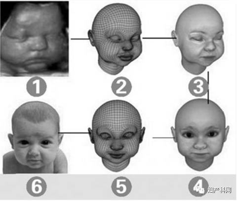 超声诊断:①胎儿面正中切面检查,下颌小并后缩,下唇较上唇明显后移.