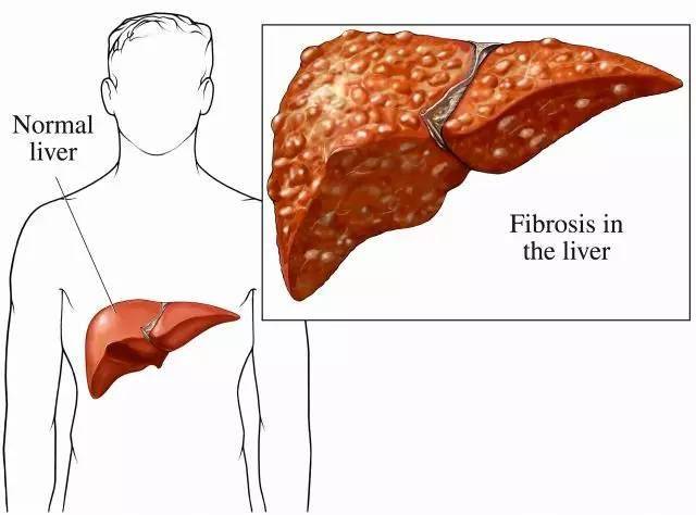 肝纤维化示意图