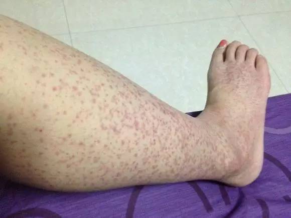 全身,尤其是四肢,会出现针头至黄豆大小的瘀点,淤斑或皮疹,严重的患者