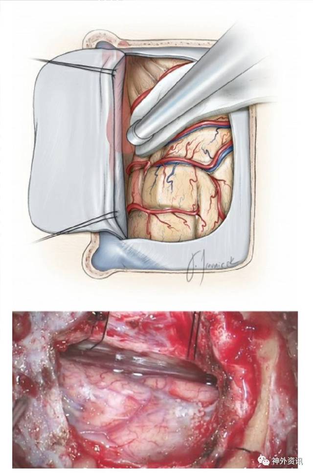 经纵裂入路开颅手术操作技巧 the neurosurgical atlas全文翻译