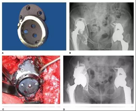 扒一扒严重髋臼骨缺损的翻修处理办法