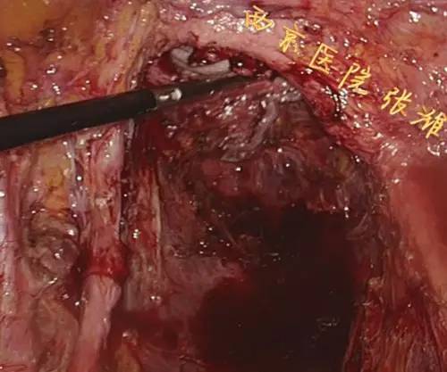 腹腔镜下后盆廓清术治疗阴道癌Ⅳa期一例