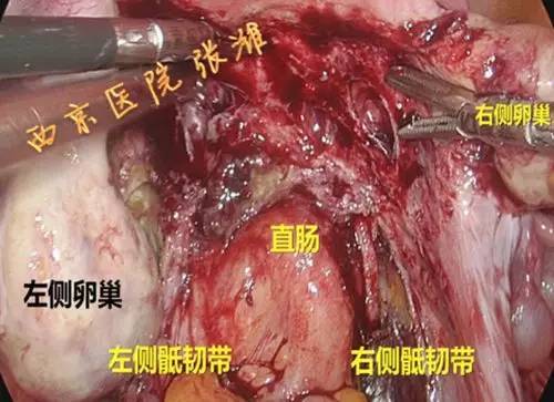 腹腔镜下后盆廓清术治疗阴道癌Ⅳa期一例