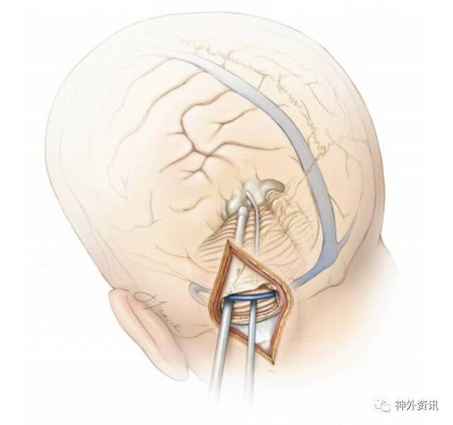 旁正中小脑上入路开颅| the neurosurgical atlas全文