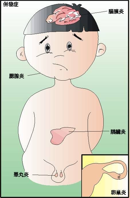 注意:儿童腮腺炎可能导致耳聋!