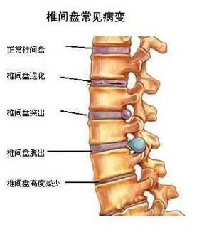 说就是你的椎间盘因为各种原因凸出来了,压迫附近的神经导致腰部疼痛