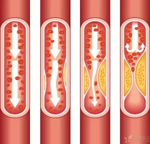血管堵住了怎么办?骗子和医生分别是这么做的