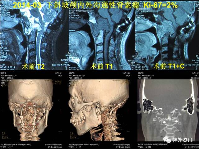 【正海-妙术视界】| 王义宝教授:下斜坡颅底内外沟通性脊索瘤的内镜经