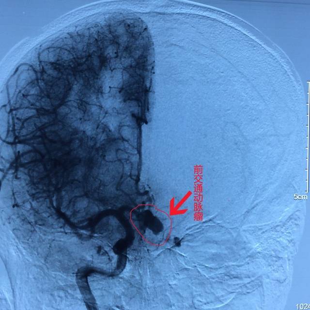 右侧翼点开颅前交通动脉瘤夹闭术