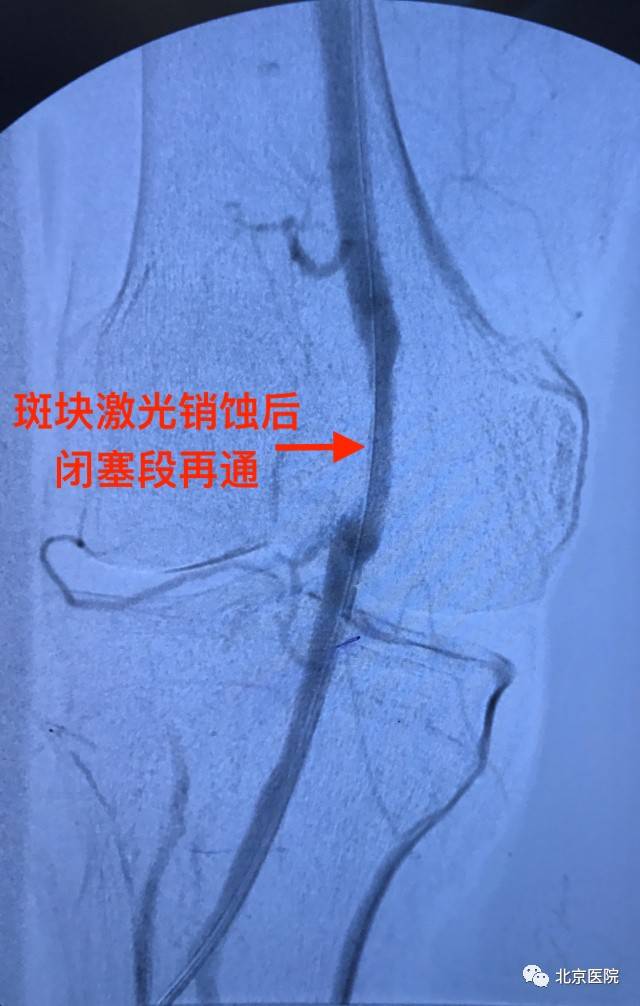 北京医院血管外科在国内率先开展激光导管斑块切除暨激光销蚀手术