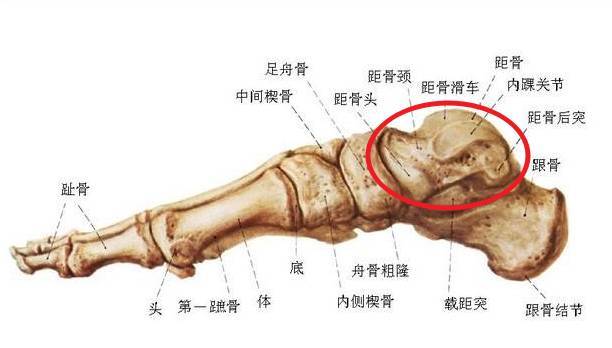 经过检查,原来李大伯不是简单的踝关节扭伤了,而是 距骨骨软骨损伤