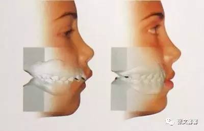 性上颌前突一般要通过拔牙带牙套来解决,骨性还是需要正颌手术来矫正