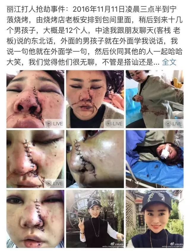 女孩丽江惨遭毁容事件,原来张若昀也是受害者之一!