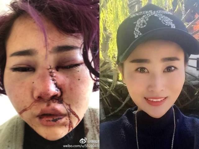 东北女孩在丽江遭毁容抢劫:她凌晨三点还在外面浪,活该被打吗?