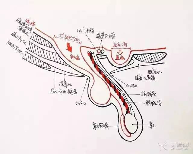 男孩腹股沟疝的发病率是女孩的3-4倍,且均为右侧好发,这可能与 男性