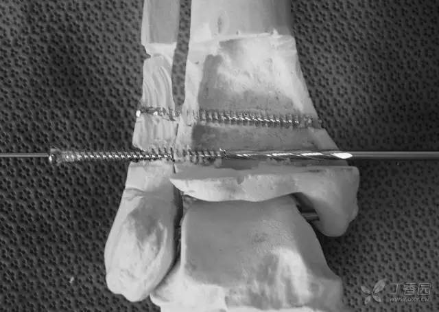 骨哥手术课堂:断裂的下胫腓联合螺钉该如何取出?