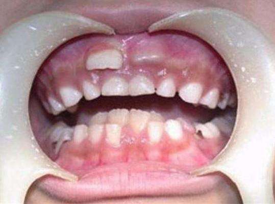 8岁小孩竟长出畸形双排牙, 牙医: 都是父母的错!