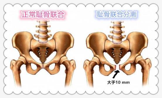 正常情况下耻骨联合间