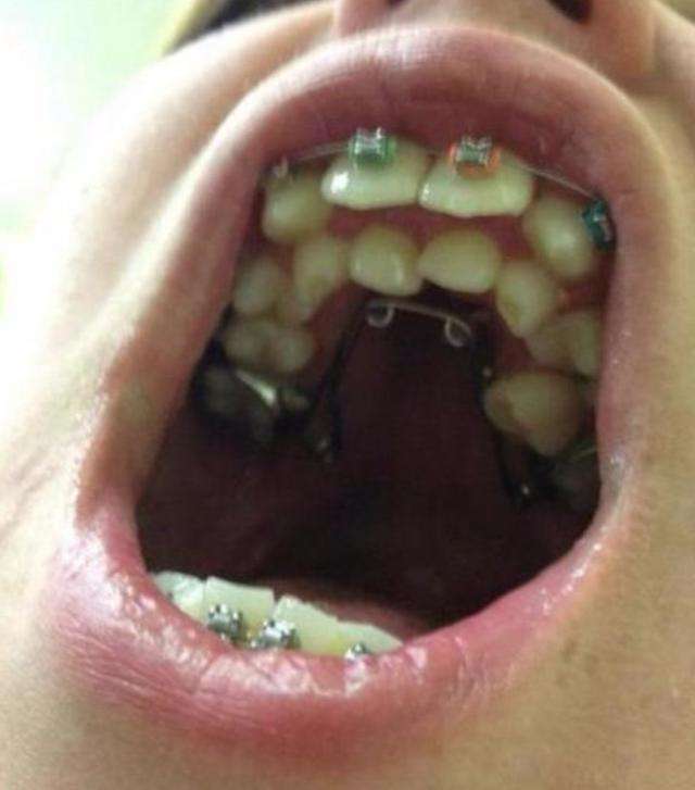 8岁小孩竟长出畸形双排牙 牙医 都是父母的错!_手机搜狐网