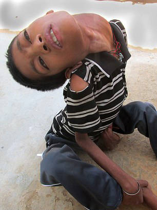 12岁印度男孩得罕见怪病 头像断了一样挂在脖子上