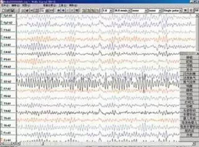 脑电图查出癫痫波,就说明有癫痫?
