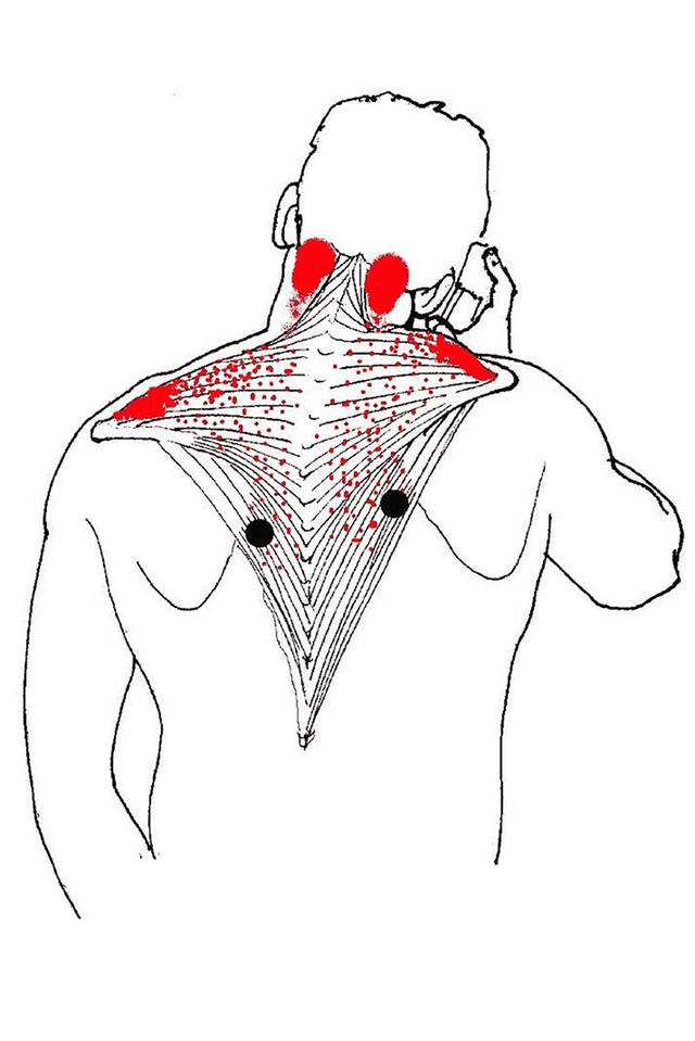 扳机点被描述为在骨骼肌纤维中可触及的紧张索条上高度局限且易激惹的