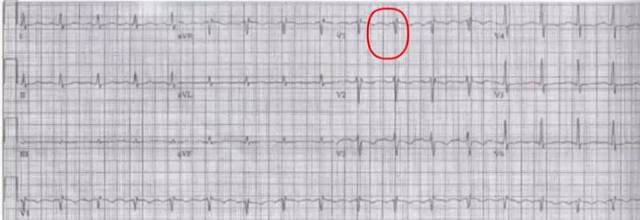 25%的患者最终诊断依靠这种心电图表现,既不敏感也非特异,可见s1q3t3