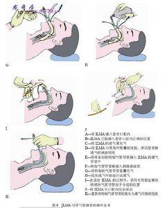 全麻气管插管引起牙齿损伤的处理