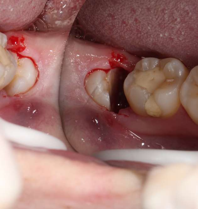 另外,不要为了口中可能渗出的血丝而猛烈漱口,保持血凝块留存于拔牙窝