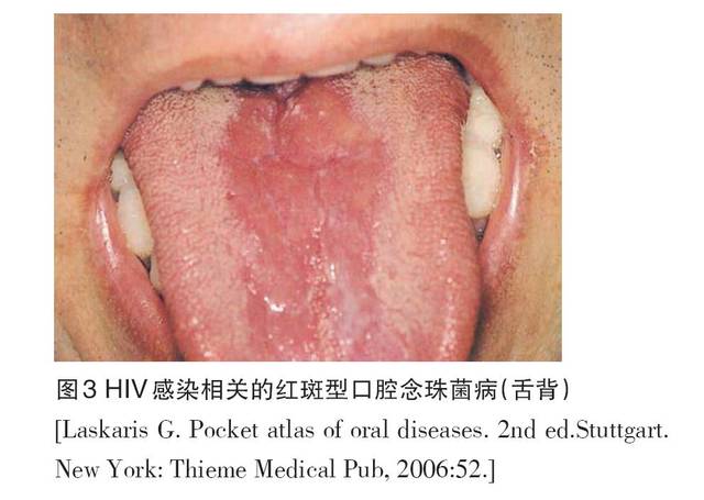 被尖锐湿疚病人口_尖锐湿犹