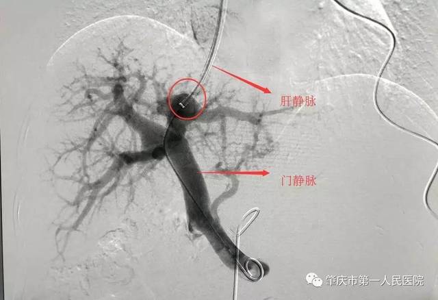 【重磅】我院独立完成首例经颈静脉肝内门体静脉分流术