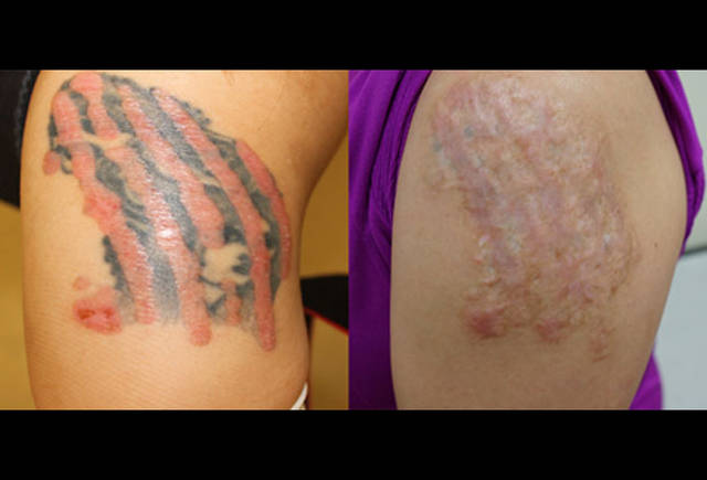 这张照片显示的是一位23岁的患者,在纹身处感染了珍珠状丘疹.