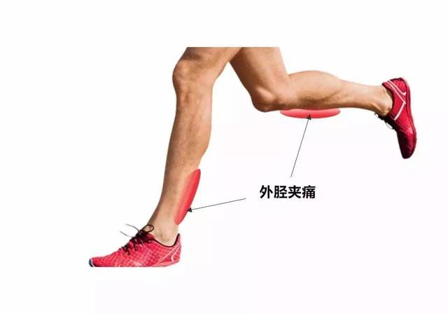 警惕 为什么跑步容易出现胫骨"骨膜炎?