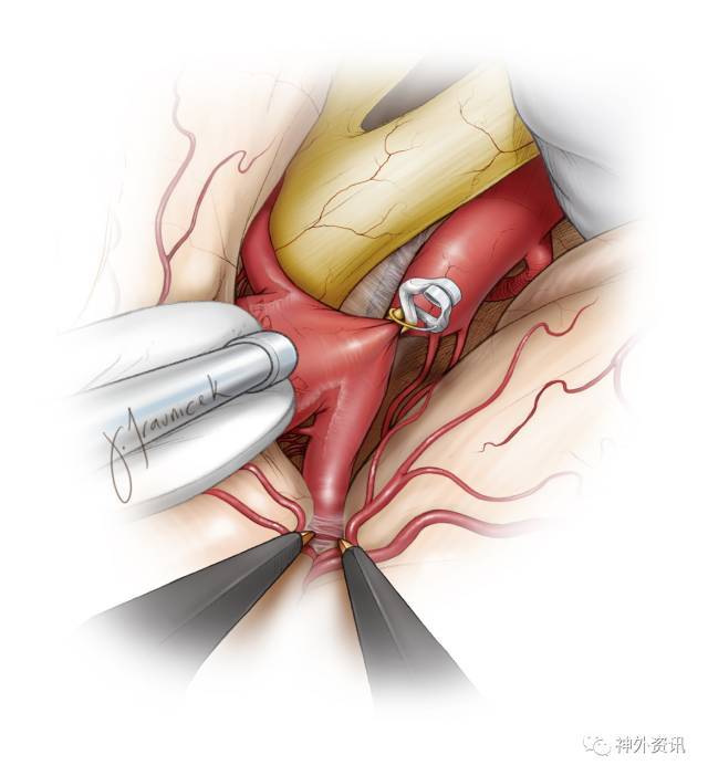 分离顺序应该是先m1,后a1,因为:解剖位于a1与动脉瘤之间的内侧瘤颈