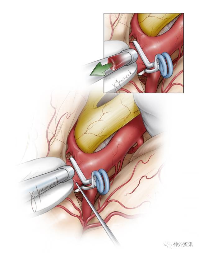 颈内动脉分叉部动脉瘤| the neurosurgical atlas全文