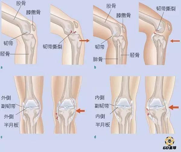 膝盖扭伤: 支撑膝盖骨部位的韧带拉伤或撕裂 膝关节前部,侧面或背部