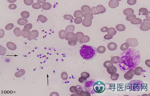 患者骨髓涂片可见大量利什曼原虫无鞭毛体