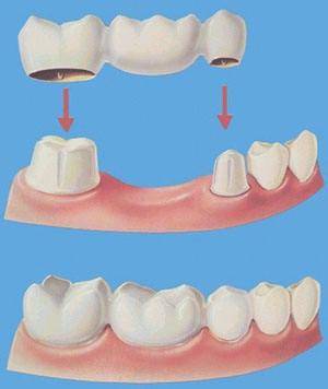 单颗牙修复的三种方法