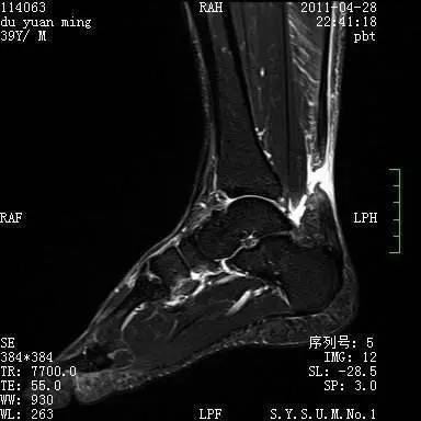 核磁共振成像也可进一步检查判断跟腱变性的程度和是否断裂