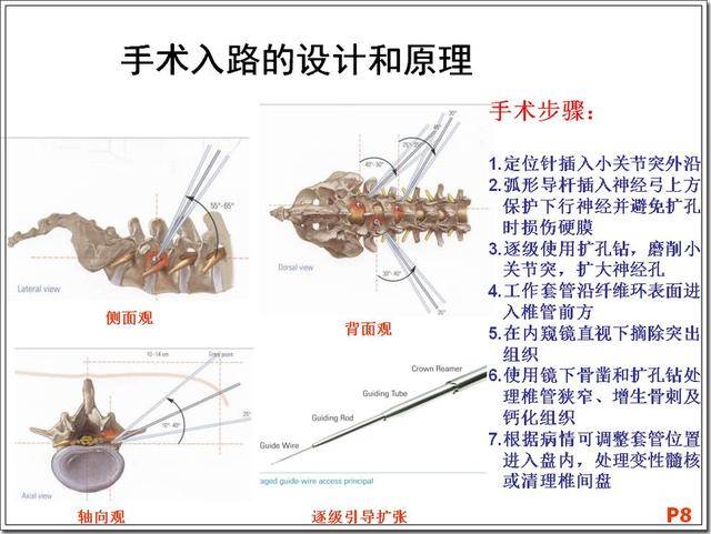 椎间孔镜微小创伤治疗腰腿痛