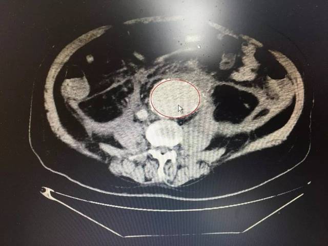 腹部ct下显示腹主动脉瘤(红色圈出部分)