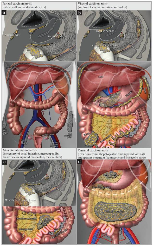 腹膜癌肿播散的示意图:(a)壁层腹膜,(b)脏层腹膜,(c)肠系膜癌肿,(d)