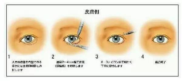 下眼睑下至术