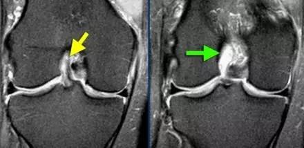 骨哥阅片课堂:前交叉韧带正常及异常 mri 手把手教