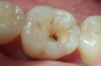 ①龋齿:初龋一般无症状,如龋洞变大而深时,可出现进食时牙齿疼痛,吃