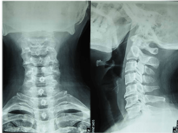 颈椎正侧位x光片
