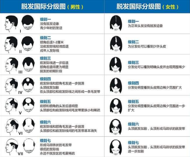 女性在发线处头发又少许的稀少,这个阶段,无论男性还是女性,脱发都不