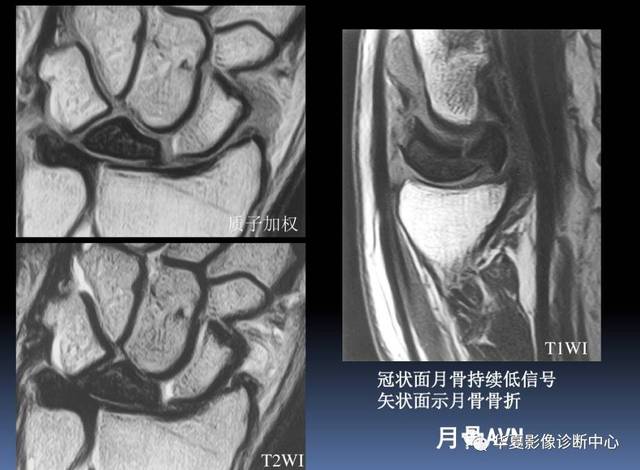 【影像基础】腕关节mri解剖及常见病诊断