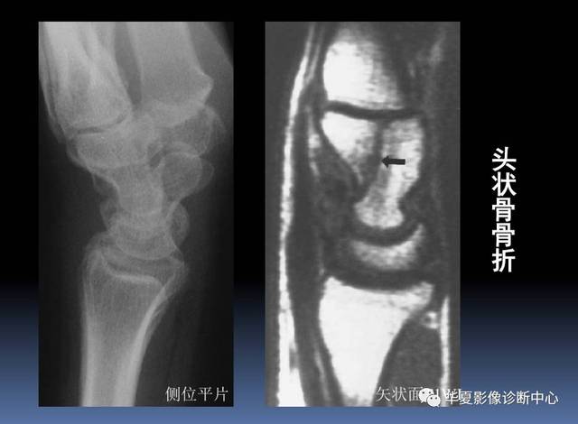 【影像基础】腕关节mri解剖及常见病诊断