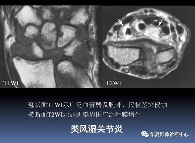 【影像基础】腕关节mri解剖及常见病诊断